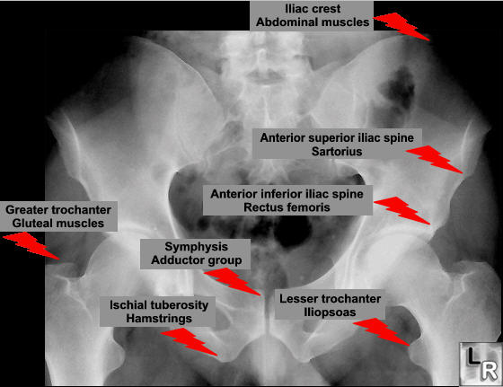 anterior superior iliac spine - meddic
